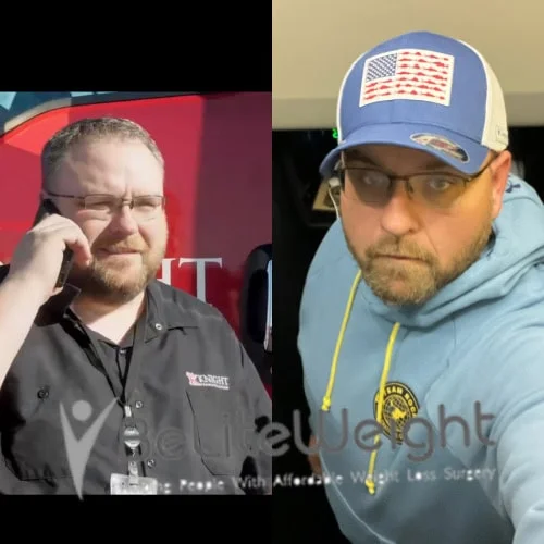 Weight Loss Surgery Gastric Sleeve before and after